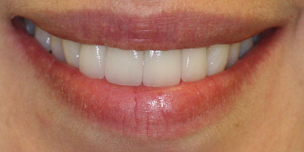 veneers Harley Street