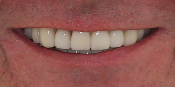 veneers Harley Street