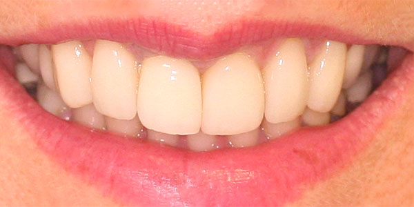 veneers Harley Street