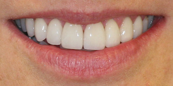 veneers Harley Street