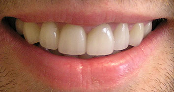 a smile makeover with 8 veneers